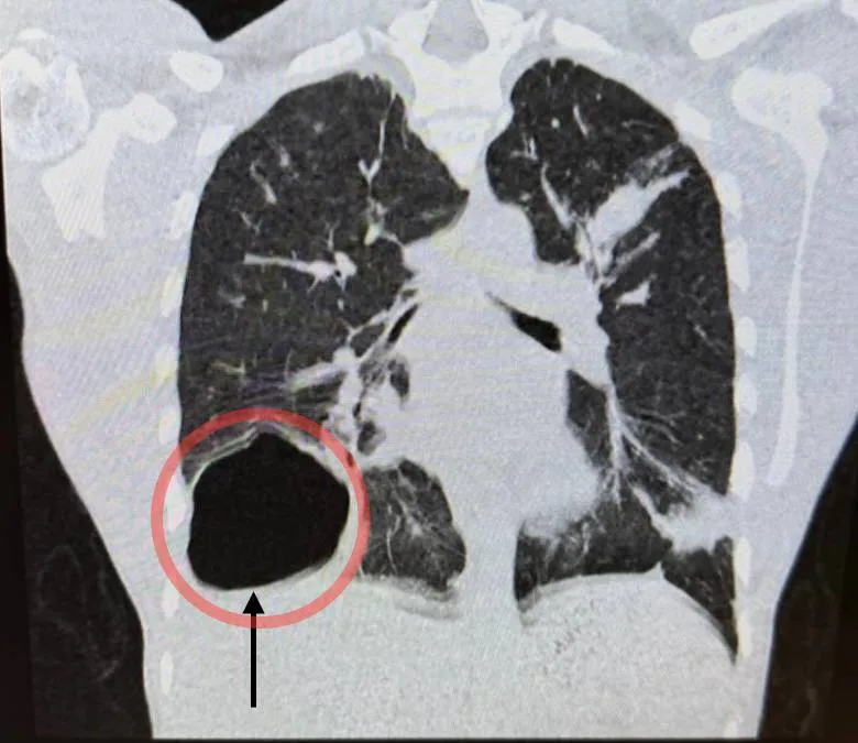 В Люберцах детские хирурги извлекли из легкого подростка гигантскую кисту с паразитами