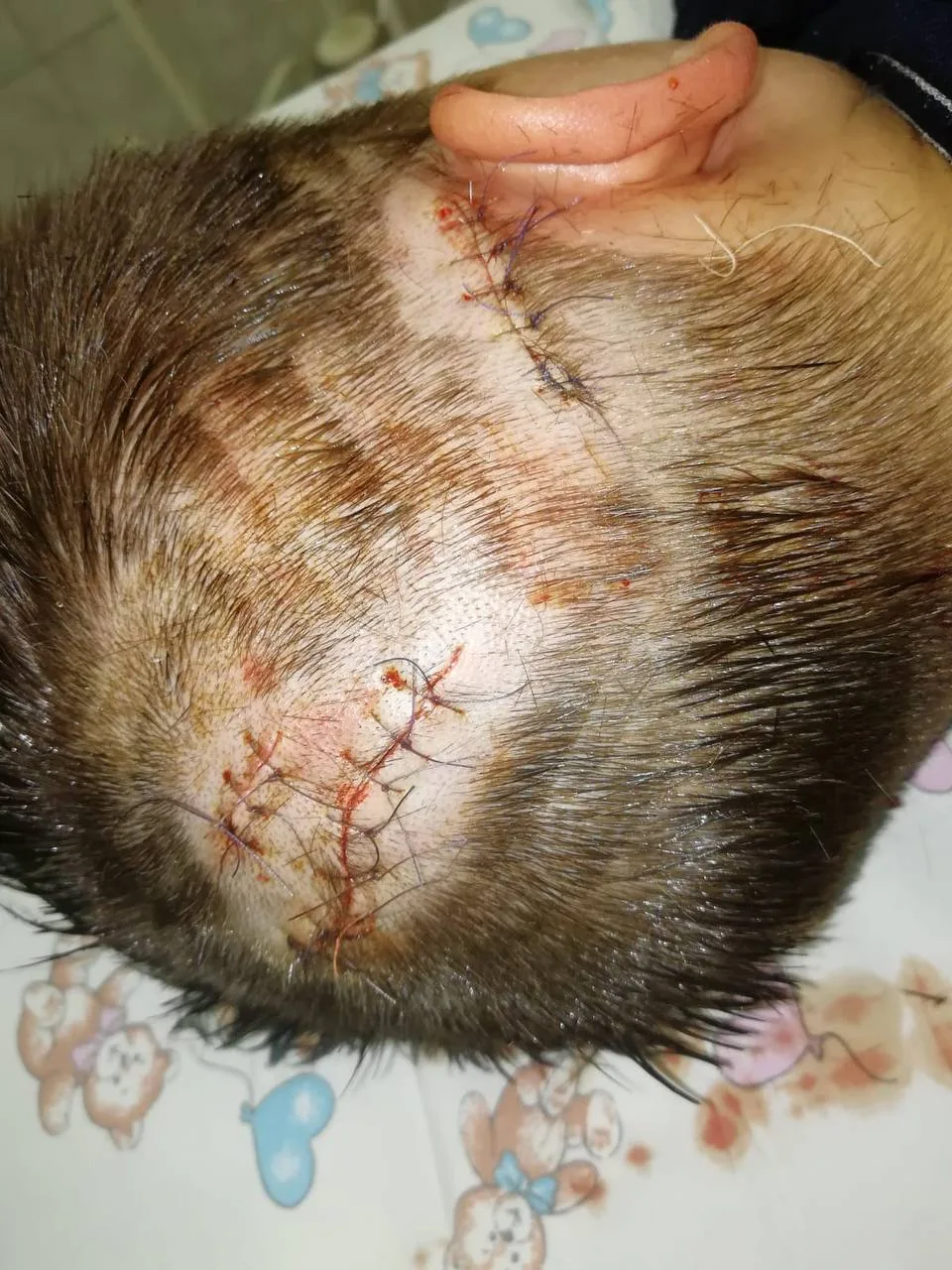 Врачи МОЦОМД Люберец оказали экстренную помощь ребёнку, пострадавшему от укусов домашнего питомца