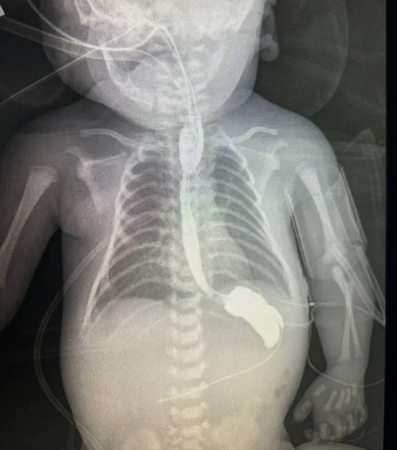 Врачи МОЦОМД в Люберцах спасли ребенка с врожденным пороком пищевода